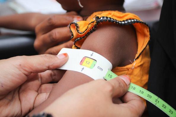 Acute malnutrition threatens half of children under five in Yemen in 2021: UN 